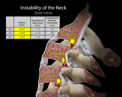 Instability of the Neck